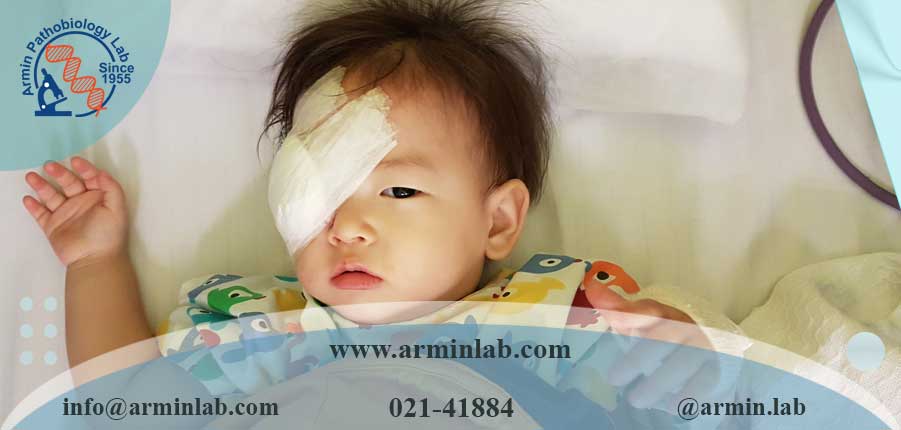 علائم شایع سرطان چشم در کودکان