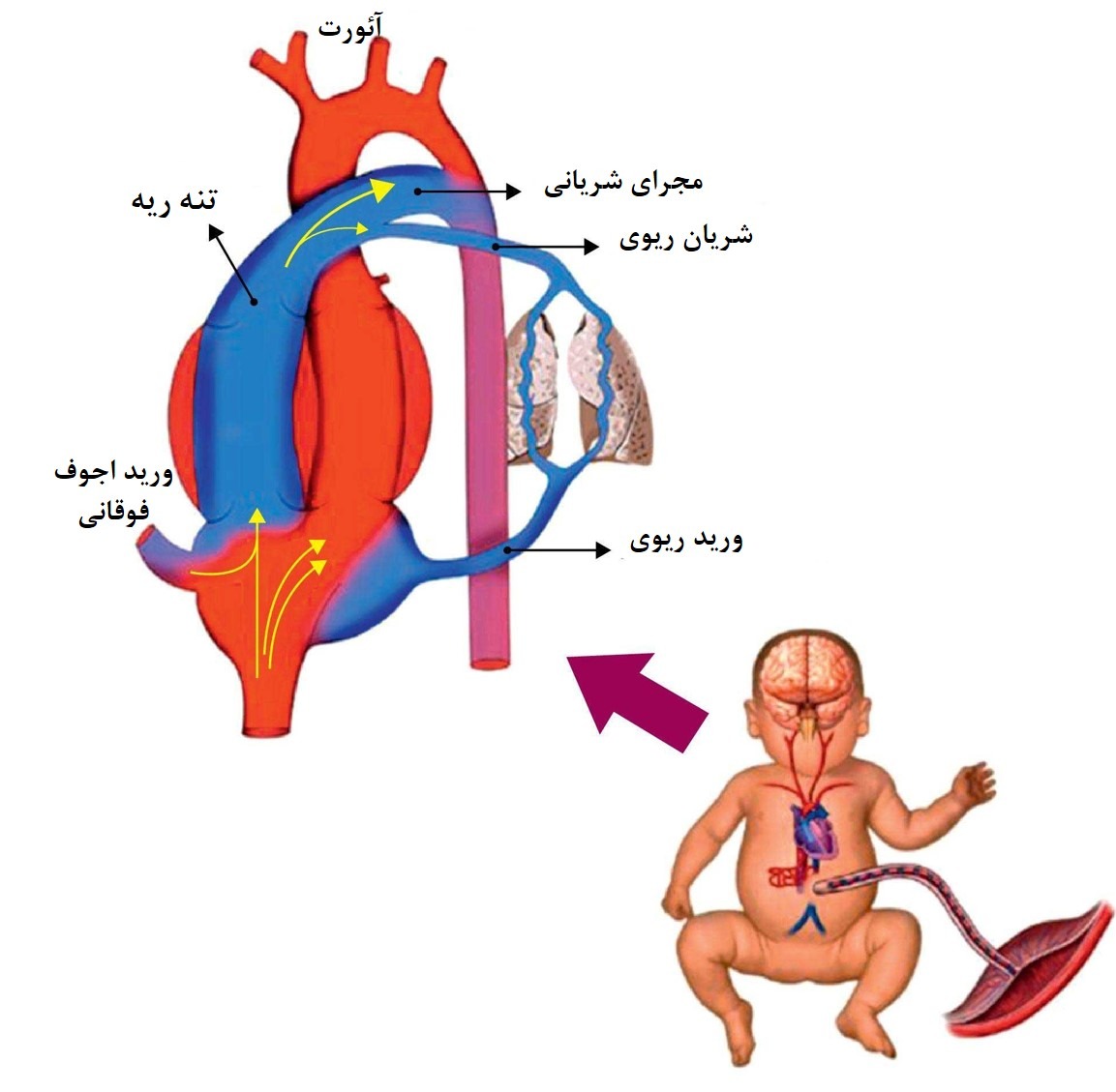 فشار خون ریوی در نوزادان 