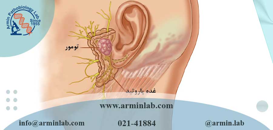 تومورهای غدد بزاقی 