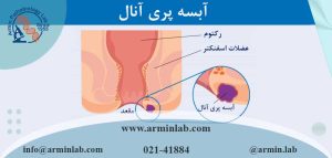 آبسه پری آنال