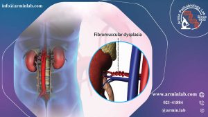 دیسپلازی فیبروماسکولار (FMD)