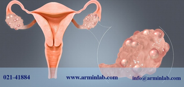 سندرم تخمدان پلی کیستیک