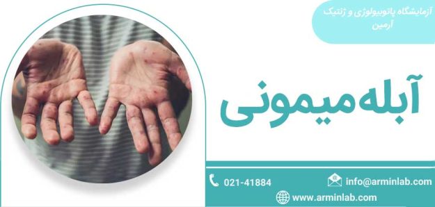 Monkeypox آبله میمونی