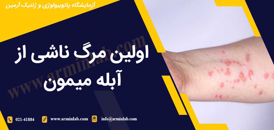 اولین مرگ ناشی از آبله میمون