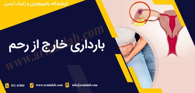 بارداری خارج از رحم