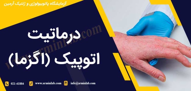 درماتیت اتوپیک (اگزما)