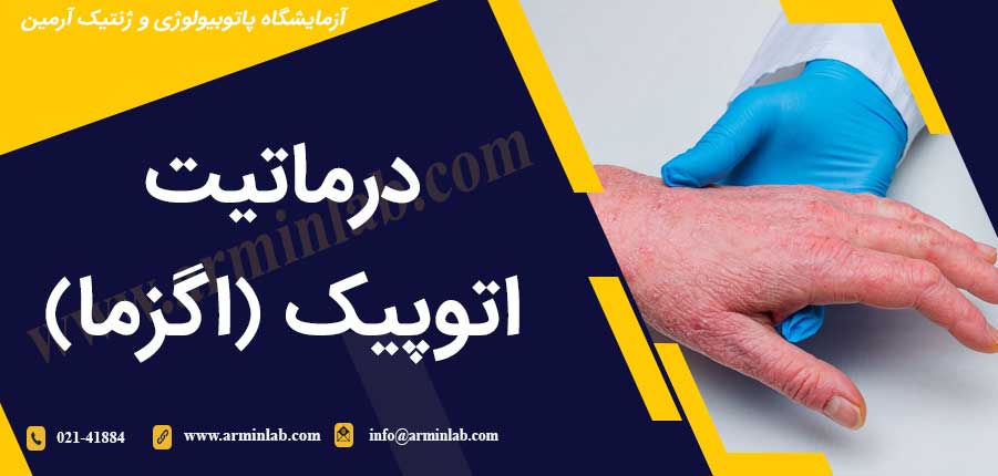 درماتیت اتوپیک (اگزما)