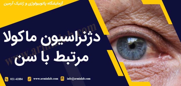 دژنراسیون ماکولا مرتبط با سن