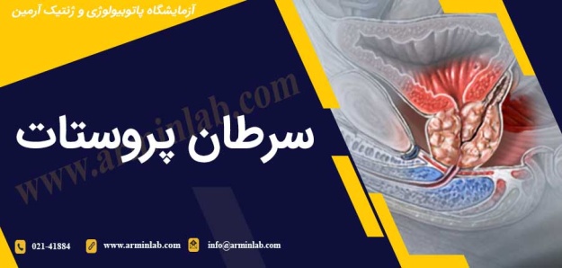سرطان پروستات