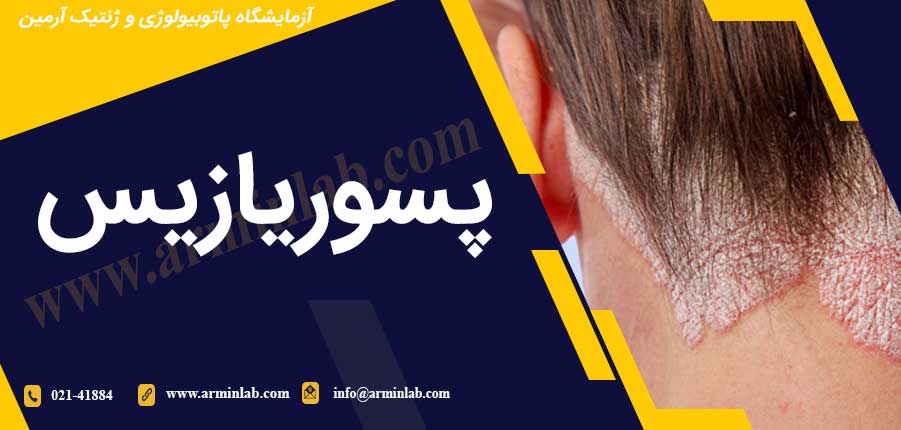 پسوریازیس