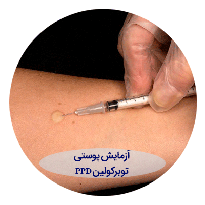 آزمایش-پوستی-توبرکولین-PPD آزمایش پوستی توبرکولین PPD