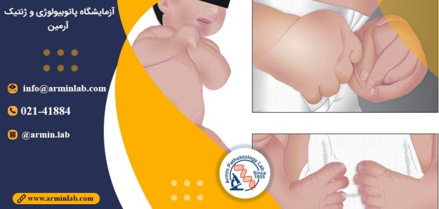 سندرم ناخنک چندگانه