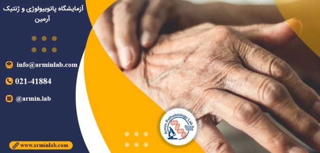 بیماری پارکینسون