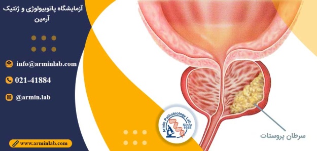 ارتباط سرطان پروستات با ژنتیک