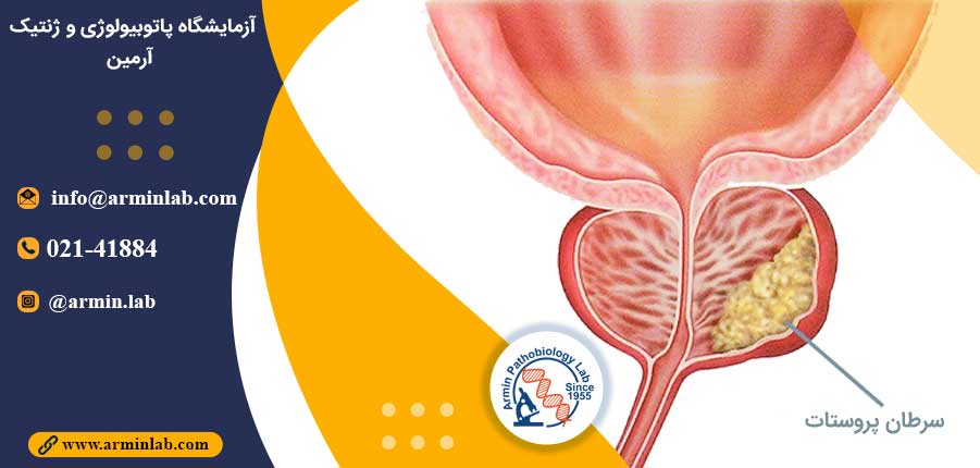 ارتباط سرطان پروستات با ژنتیک