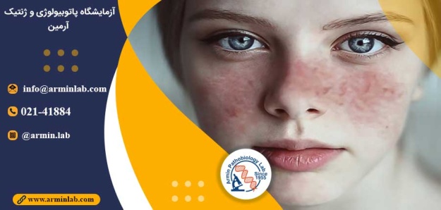 ارتباط بیماری لوپوس و RNA