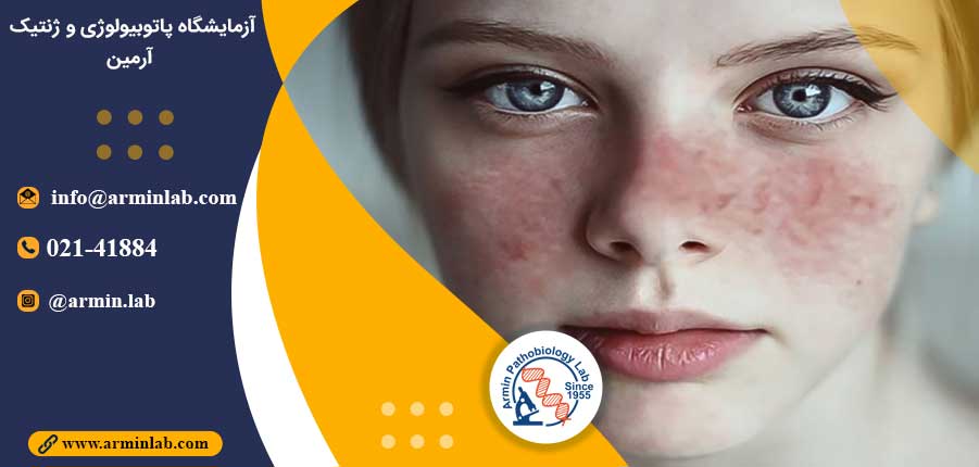 ارتباط بیماری لوپوس و RNA