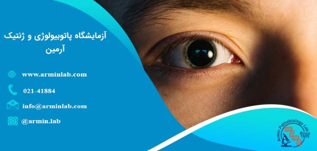 بیماری آنیریدیا (Aniridia) چیست؟