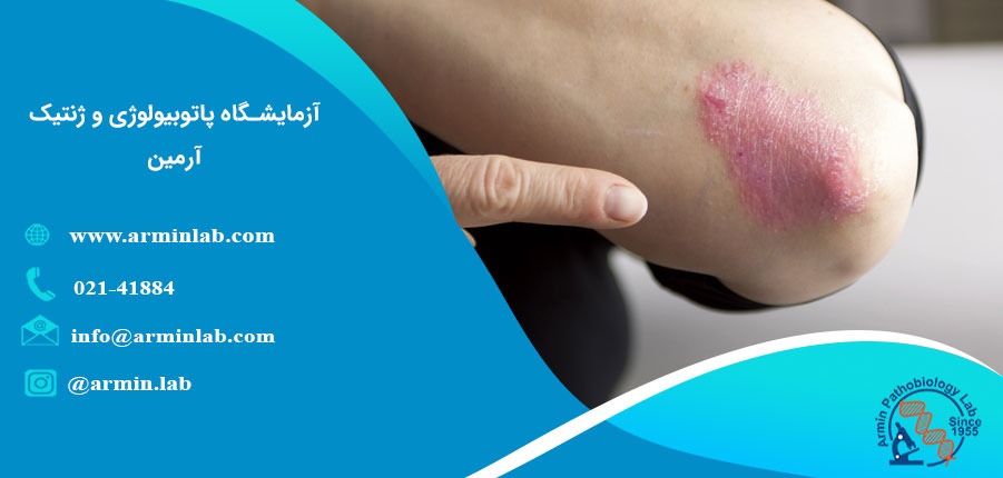 مدیریت التهاب مزمن مرتبط با پسوریازیس