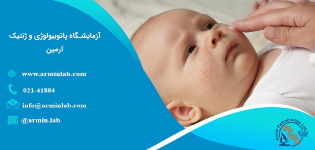 عرق سوز شدن نوزاد و درمان آن