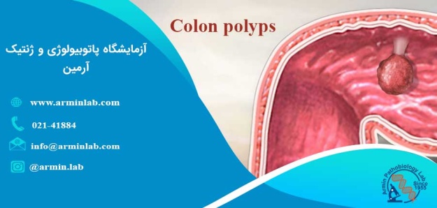 پولیپ روده بزرگ