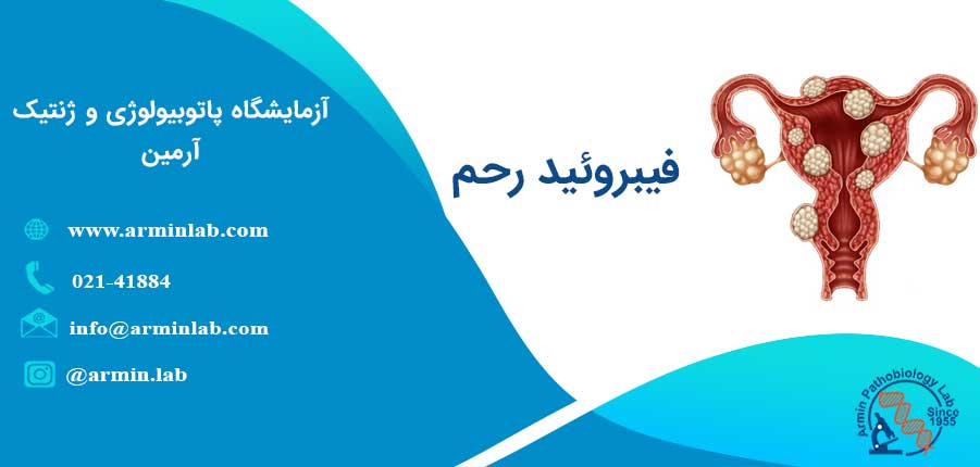 فیبروئید رحم