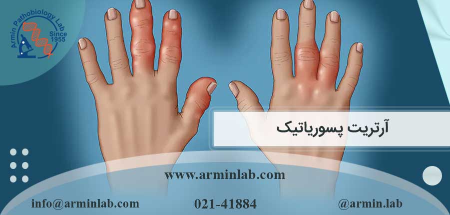 آرتریت پسوریاتیک