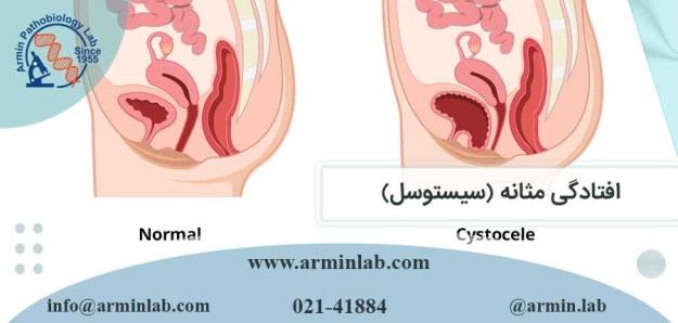 افتادگی مثانه (سیستوسل)