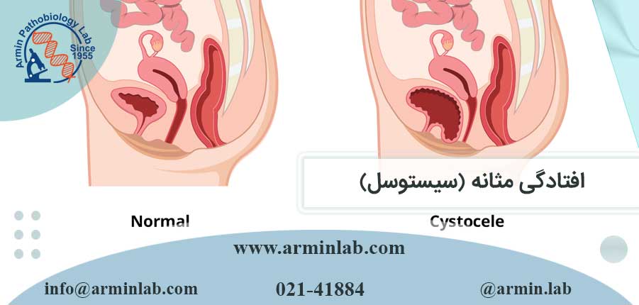 افتادگی مثانه (سیستوسل)