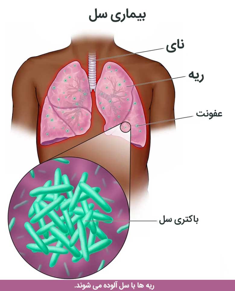 بیماری سل