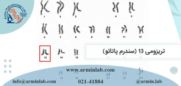 تریزومی 13 (سندرم پاتائو)