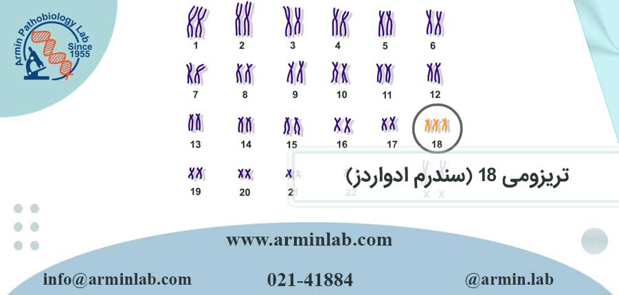 تریزومی 18 (سندرم ادواردز)