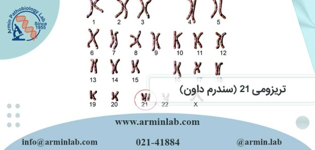 تریزومی 21 (سندرم داون)