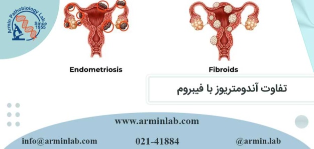 تفاوت آندومتریوز با فیبروم