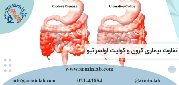 تفاوت بیماری کرون و کولیت اولسراتیو