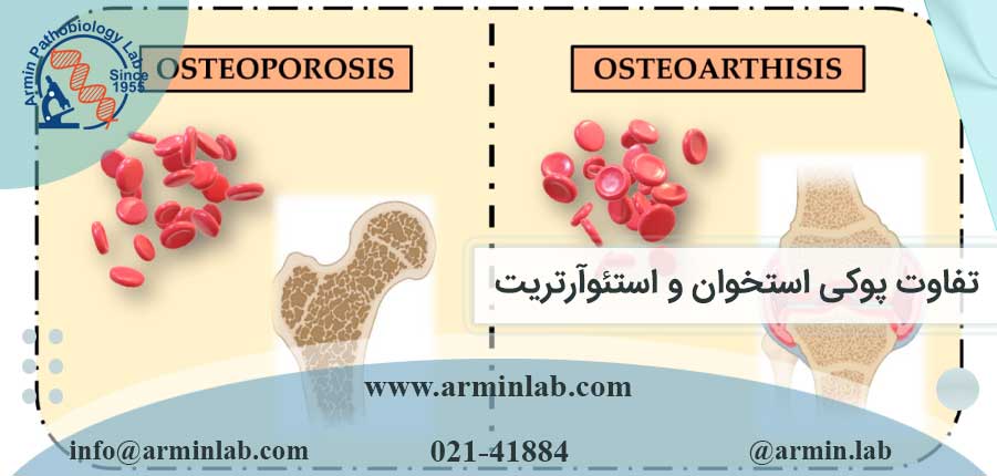تفاوت پوکی استخوان و استئوآرتریت
