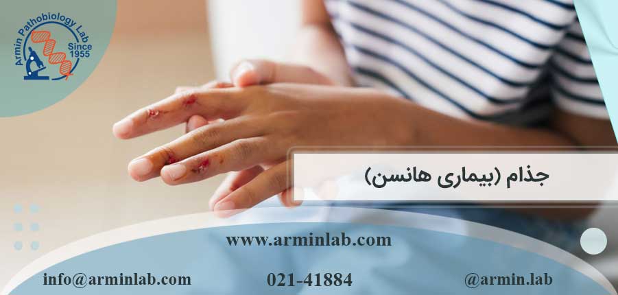 جذام-(بیماری-هانسن)-arminlab جذام (بیماری هانسن)