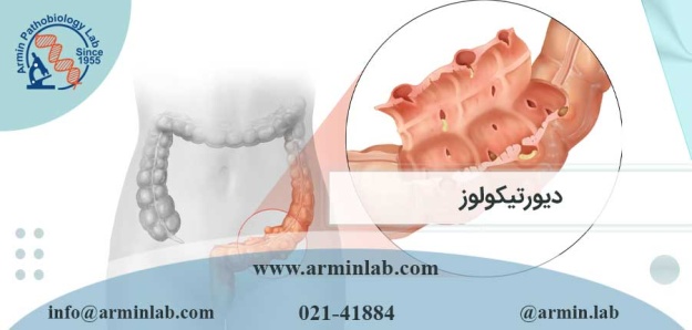 دیورتیکولوز