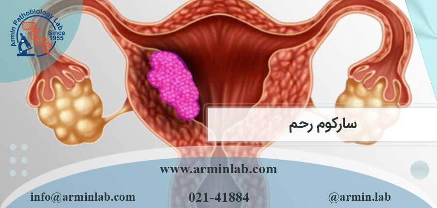 سارکوم رحم