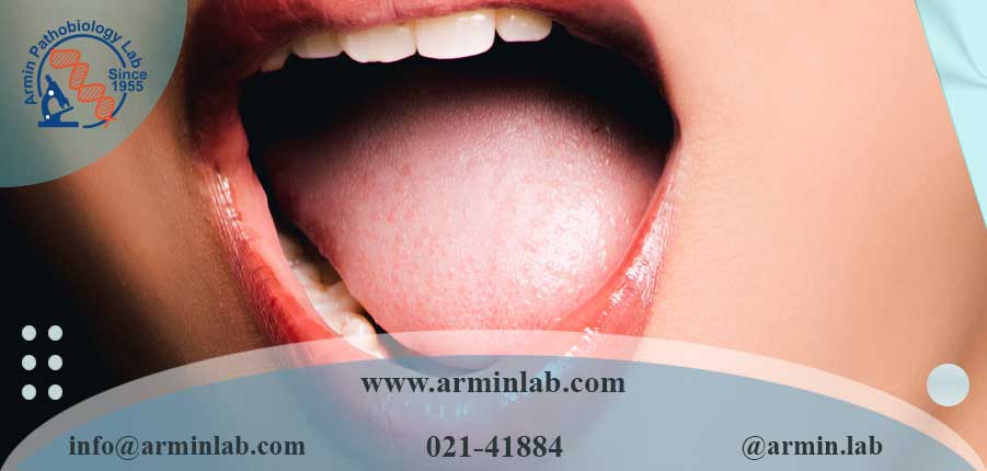 سندرم سوزش دهان (BMS)