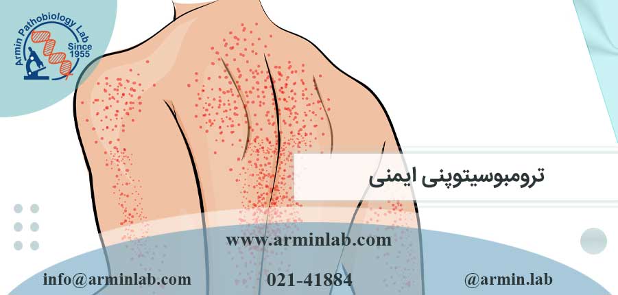 ترومبوسیتوپنی ایمنی
