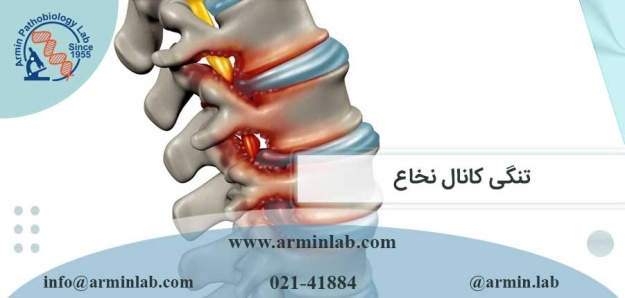 تنگی کانال نخاع