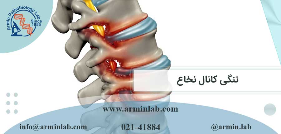 تنگی کانال نخاع