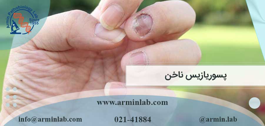 پسوریازیس-ناخن-arminlab پسوریازیس ناخن