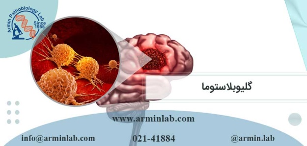 گلیوبلاستوما