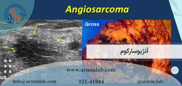 آنژیوسارکوم