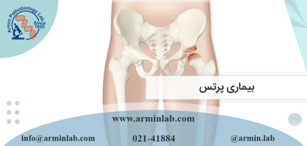 بیماری پرتس