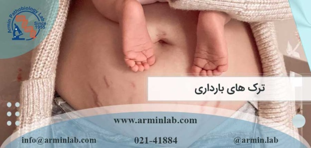ترک-های-بارداری-arminlab ترک های بارداری