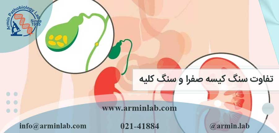 تفاوت سنگ کیسه صفرا و سنگ کلیه