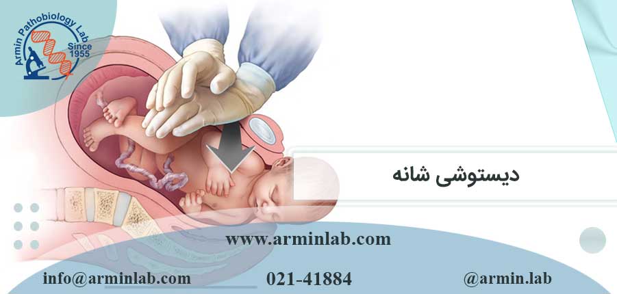 دیستوشی شانه چیست؟